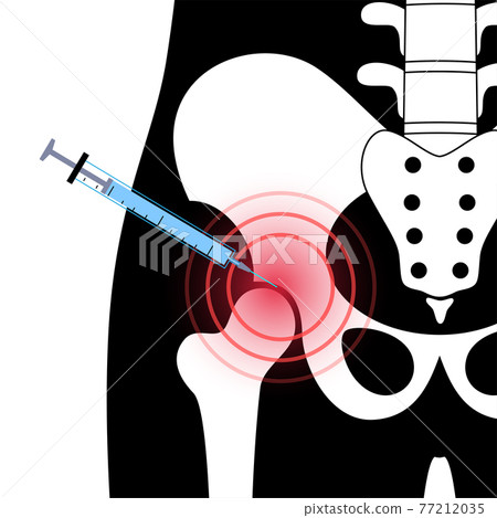 Hip joint injection Hip joint injection 77212035