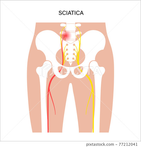 Muscular pelvis sciatica 77212041