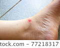 Red spot on Asian woman skin. Insect Sting Allergy. Health and medical background. 77218317