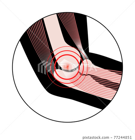 Medial epicondylitis golfer elbow Medial epicondylitis golfer elbow 77244851