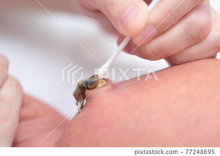 媽媽給新生兒消毒肚臍 77248695