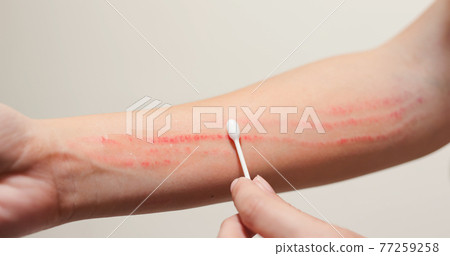 Apply ointment on forearm 77259258