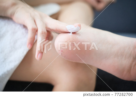 Girl smears cream dry feet covered with cracks, Close up concept. 77282700