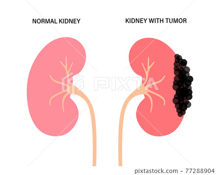 Kidney disease concept 77288904