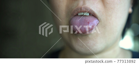 Bleeding cut from biting her own tongue blood close-up 77313892