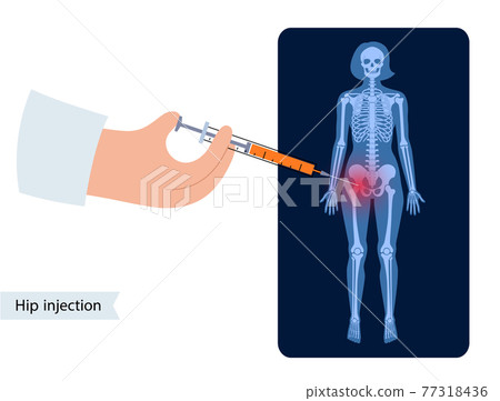 Hip joint injection 77318436