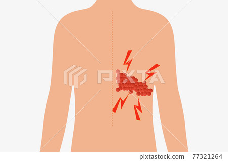 Herpes zoster Herpes zoster 77321264