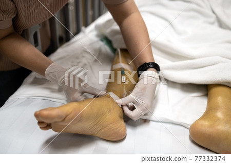 Hands of nurse is assisting a patient lying on a hospital bed by giving saline solution to the leg or a needle to puncture into ankle to deliver platelets due to swelling the patient's hand or wrist 77332374