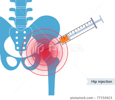 Hip joint injection 77350923