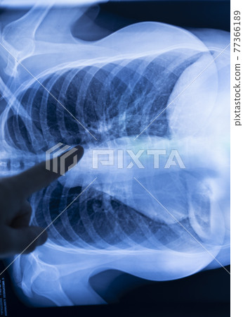 Lungs ribs xray scan Lungs ribs xray scan 77366189
