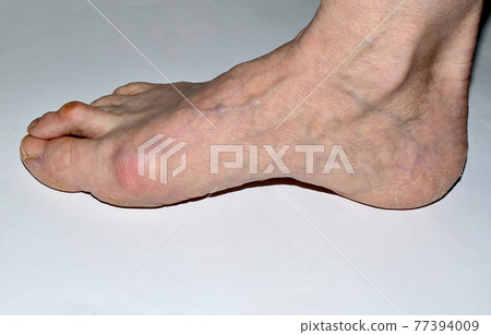 The picture shows the right foot of the leg affected by the disease of the hallux valgus. The picture shows the right foot of the leg affected by the disease of the hallux valgus. 77394009