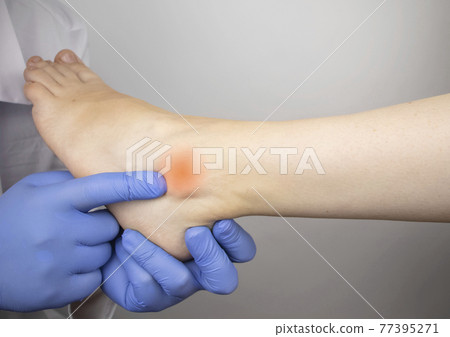 The podiatrist examines the heel and its ridges in a patient who complains of acute pain. Suspected plantar fasciitis, achillodynia, or heel spur. The podiatrist examines the heel and its ridges in a patient who complains of acute pain. Suspected plantar fasciitis, achillodynia, or heel spur. 77395271