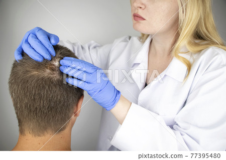 A trichologist examines the hair of a man who begins alopecia. Consultation with a dermatologist. Hair loss, alopecia, pruritus, burning head or seborrhea 77395480