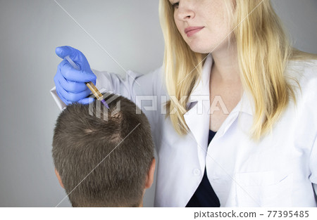 The doctor trichologist conducts mesotherapy or plasma therapy. Treatment of alopecia. Hair loss, alopecia, pruritus, burning head or seborrhea 77395485