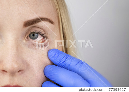 An ophthalmologist examines a woman who complains of a burning sensation and pain in her eyes. Eye fatigue from a computer screen or telephone (sand sensation on the cornea). The concept of early 77395627
