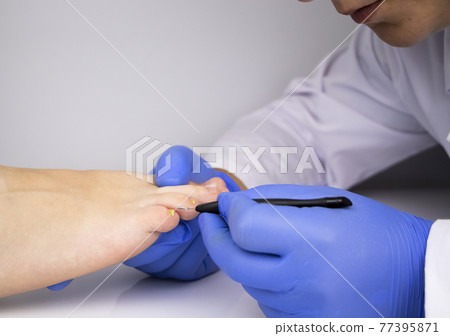 A dermatologist examines a toenail affected by a fungus. Treatment of mycosis and assistance to patients with fungal diseases. A dermatologist examines a toenail affected by a fungus. Treatment of mycosis and assistance to patients with fungal diseases. 77395871