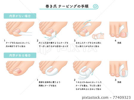 Ingrown nails, ingrown nails, taping procedure, illustration Ingrown nails, ingrown nails, taping procedure, illustration 77409323