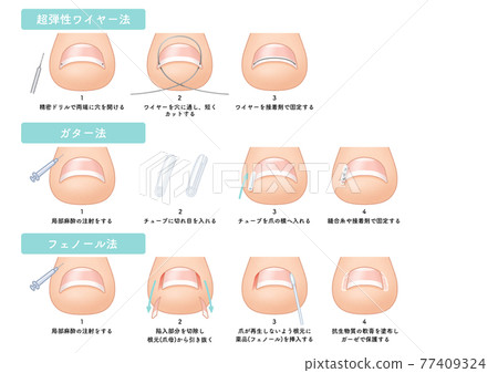 Nailing Gutter Ingrown nails, ingrown toenails, gutter method,... - Stock Illustration ...