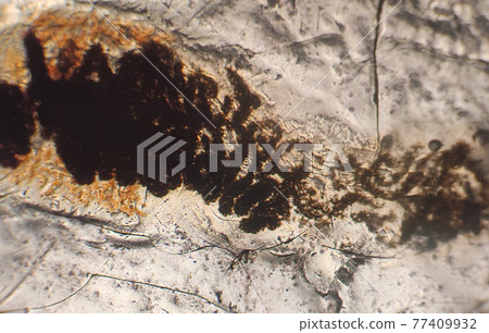 Pinworms eggs Enterobius vermicularis in stool examination under microscope.Pinworm eggs are flatted asymmetrically on one side. 77409932
