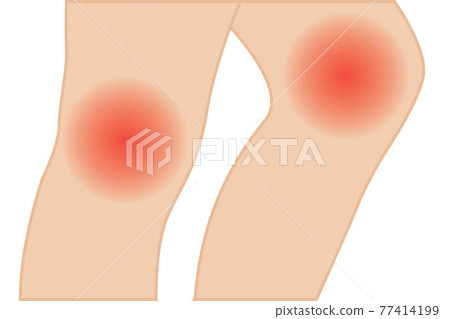 Knee joint pain vector illustration. hyperextension treatment 77414199