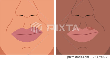 Vector illustration of herpes on the lip, cold sore, herpes simplex. Vector illustration of herpes on the lip, cold sore, herpes simplex. 77479027