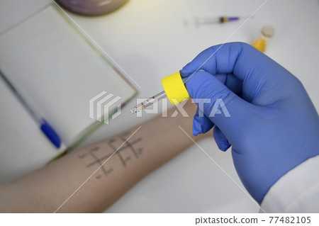 An allergist doctor in the laboratory conducts a prik allergy test. Skin test for household, food, epidermal allergic reactions 77482105