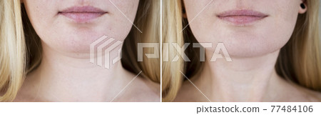 Second chin lift in women. Photos before and after plastic surgery, mentoplasty or facebuilding. Chin fat removal and face contour correction Second chin lift in women. Photos before and after plastic surgery, mentoplasty or facebuilding. Chin fat removal and face contour correction 77484106