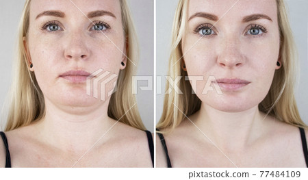 Second chin lift in women. Photos before and after plastic surgery, mentoplasty or facebuilding. Chin fat removal and face contour correction 77484109