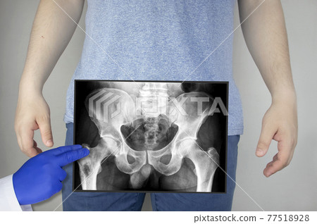 X-ray of the pelvic bones of a man. A doctor radiologist is studying an x-ray examination. A hip joint is placed on the patient body X-ray of the pelvic bones of a man. A doctor radiologist is studying an x-ray examination. A hip joint is placed on the patient body 77518928