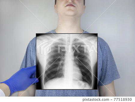X-ray of the chest of a man. A doctor radiologist is studying an x-ray examination. A picture of the organs of the chest cavity is attached to the patient body X-ray of the chest of a man. A doctor radiologist is studying an x-ray examination. A picture of the organs of the chest cavity is attached to the patient body 77518930