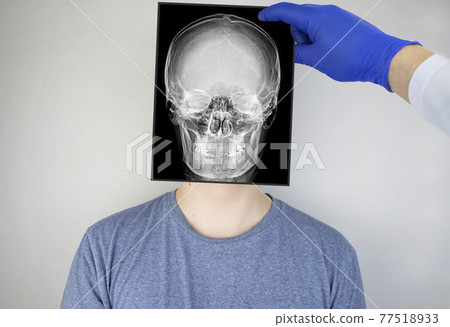 Survey radiography of the skull of a man. A doctor radiologist is studying an x-ray examination. A snapshot of the skull is placed on the patient head. Survey radiography of the skull of a man. A doctor radiologist is studying an x-ray examination. A snapshot of the skull is placed on the patient head. 77518933