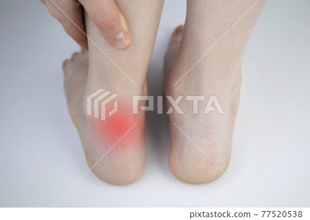 An orthopedic doctor examines a woman's leg. Achilles tendon and ankle diseases. Inflammation of the heel and foot, achillobursitis and achillotomy, rheumatism, tendon rupture An orthopedic doctor examines a woman's leg. Achilles tendon and ankle diseases. Inflammation of the heel and foot, achillobursitis and achillotomy, rheumatism, tendon rupture 77520538