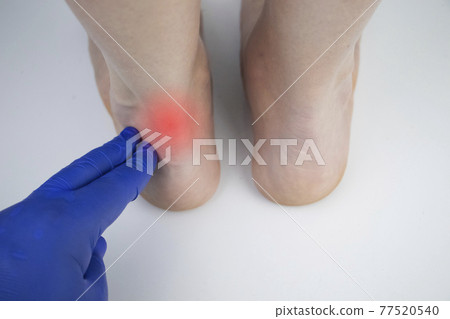 An orthopedic doctor examines a woman's leg. Achilles tendon and ankle diseases. Inflammation of the heel and foot, achillobursitis and achillotomy, rheumatism, tendon rupture An orthopedic doctor examines a woman's leg. Achilles tendon and ankle diseases. Inflammation of the heel and foot, achillobursitis and achillotomy, rheumatism, tendon rupture 77520540