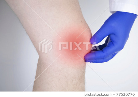 A man suffers from knee pain. Examination by an orthopedist and traumatologist. Redness and swelling of the legs, torn meniscus or knee bursitis 77520770