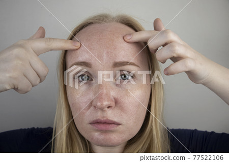 Oily and problem skin. Portrait of a blonde girl with acne, oily skin and pigmentation 77522106