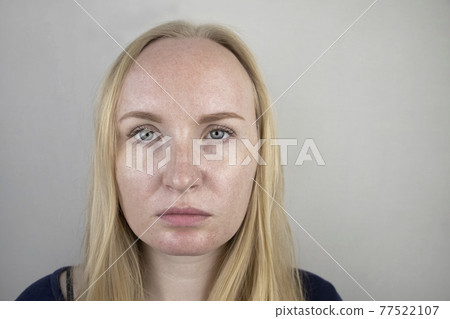 Oily and problem skin. Portrait of a blonde girl with acne, oily skin and pigmentation Oily and problem skin. Portrait of a blonde girl with acne, oily skin and pigmentation 77522107