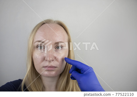 Oily and problem skin. Portrait of a blonde girl with acne, oily skin and pigmentation Oily and problem skin. Portrait of a blonde girl with acne, oily skin and pigmentation 77522110
