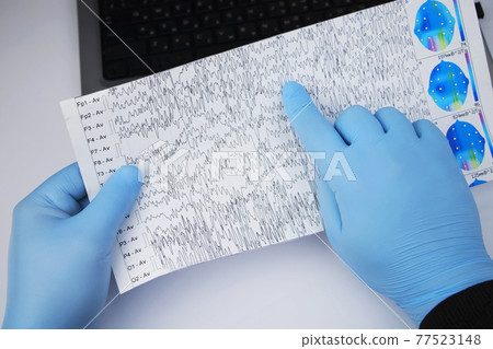 A neurologist examines an encephalogram of a patient brain. Schedule of electroencephalograms - study of brain currents for signs of epilepsy and pathologies of the nervous system A neurologist examines an encephalogram of a patient brain. Schedule of electroencephalograms - study of brain currents for signs of epilepsy and pathologies of the nervous system 77523148