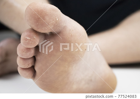 Fungus on the leg close-up isolated on a white background. The concept of dermatology, the treatment of fungal infections and ringworm. Macro photo of human parasites on the foot of a man. Fungus on the leg close-up isolated on a white background. The concept of dermatology, the treatment of fungal infections and ringworm. Macro photo of human parasites on the foot of a man. 77524083