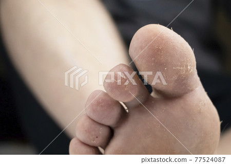 Fungus on the leg close-up isolated on a white background. The concept of dermatology, the treatment of fungal infections and ringworm. Macro photo of human parasites on the foot of a man. Fungus on the leg close-up isolated on a white background. The concept of dermatology, the treatment of fungal infections and ringworm. Macro photo of human parasites on the foot of a man. 77524087
