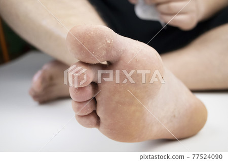 Fungus on the leg close-up isolated on a white background. The concept of dermatology, the treatment of fungal infections and ringworm. Macro photo of human parasites on the foot of a man. Fungus on the leg close-up isolated on a white background. The concept of dermatology, the treatment of fungal infections and ringworm. Macro photo of human parasites on the foot of a man. 77524090