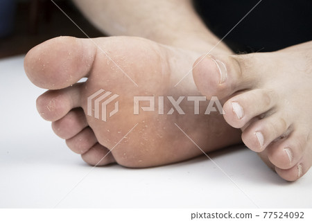 Fungus on the leg close-up isolated on a white background. The concept of dermatology, the treatment of fungal infections and ringworm. Macro photo of human parasites on the foot of a man. Fungus on the leg close-up isolated on a white background. The concept of dermatology, the treatment of fungal infections and ringworm. Macro photo of human parasites on the foot of a man. 77524092