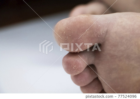 Fungus on the leg close-up isolated on a white background. The concept of dermatology, the treatment of fungal infections and ringworm. Macro photo of human parasites on the foot of a man. Fungus on the leg close-up isolated on a white background. The concept of dermatology, the treatment of fungal infections and ringworm. Macro photo of human parasites on the foot of a man. 77524096