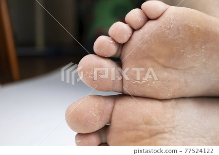 Fungus on the leg close-up isolated on a white background. The concept of dermatology, the treatment of fungal infections and ringworm. Macro photo of human parasites on the foot of a man. 77524122