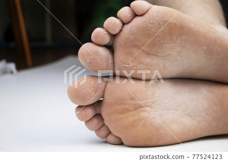 Fungus on the leg close-up isolated on a white background. The concept of dermatology, the treatment of fungal infections and ringworm. Macro photo of human parasites on the foot of a man. Fungus on the leg close-up isolated on a white background. The concept of dermatology, the treatment of fungal infections and ringworm. Macro photo of human parasites on the foot of a man. 77524123