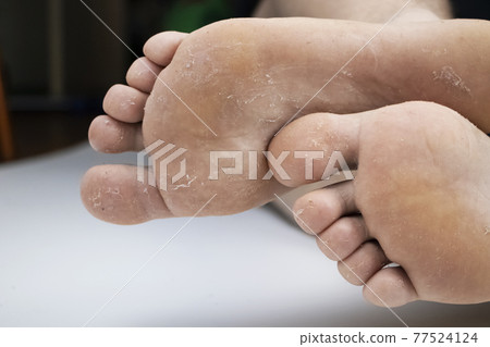 Fungus on the leg close-up isolated on a white background. The concept of dermatology, the treatment of fungal infections and ringworm. Macro photo of human parasites on the foot of a man. 77524124