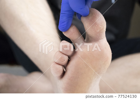 Fungus on the leg close-up isolated on a white background. The concept of dermatology, the treatment of fungal infections and ringworm. Macro photo of human parasites on the foot of a man. 77524130