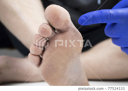 Fungus on the leg close-up isolated on a white background. The concept of dermatology, the treatment of fungal infections and ringworm. Macro photo of human parasites on the foot of a man. Fungus on the leg close-up isolated on a white background. The concept of dermatology, the treatment of fungal infections and ringworm. Macro photo of human parasites on the foot of a man. 77524131