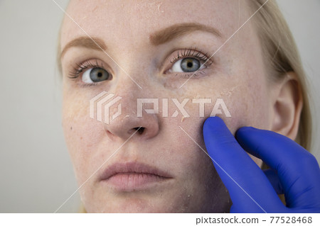 A woman examines dry skin on her face. Peeling, coarsening, discomfort, skin sensitivity. Patient at the appointment of a dermatologist or cosmetologist, selection of cream for dryness A woman examines dry skin on her face. Peeling, coarsening, discomfort, skin sensitivity. Patient at the appointment of a dermatologist or cosmetologist, selection of cream for dryness 77528468