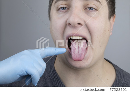 White curd on the tongue. A physician or gastroenterologist examines a man tongue. Patient has poor oral hygiene or a symptom of illness White curd on the tongue. A physician or gastroenterologist examines a man tongue. Patient has poor oral hygiene or a symptom of illness 77528501